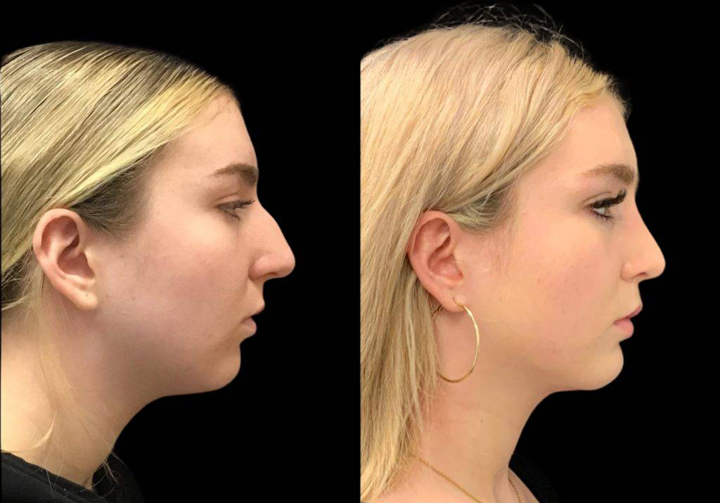 19-year-old-female-neck-liposuction-before-and-after-side-view-30719.jpg