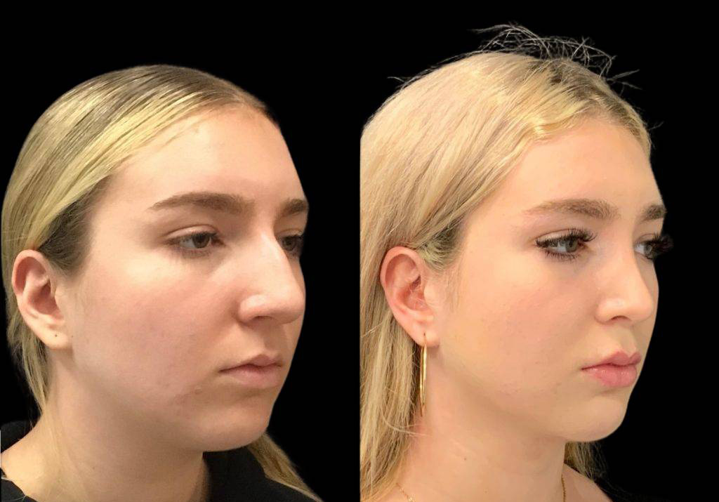 19-year-old-female-neck-liposuction-before-and-after-three-quarter-view.jpg