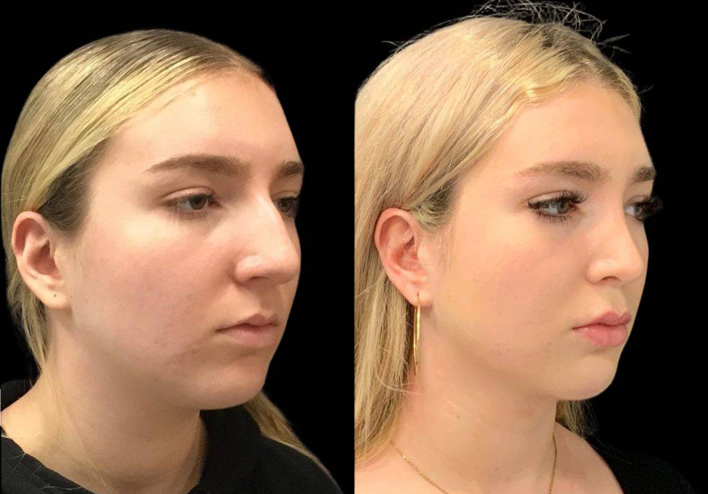 19-year-old-female-neck-liposuction-before-and-after-three-quarter-view.jpg