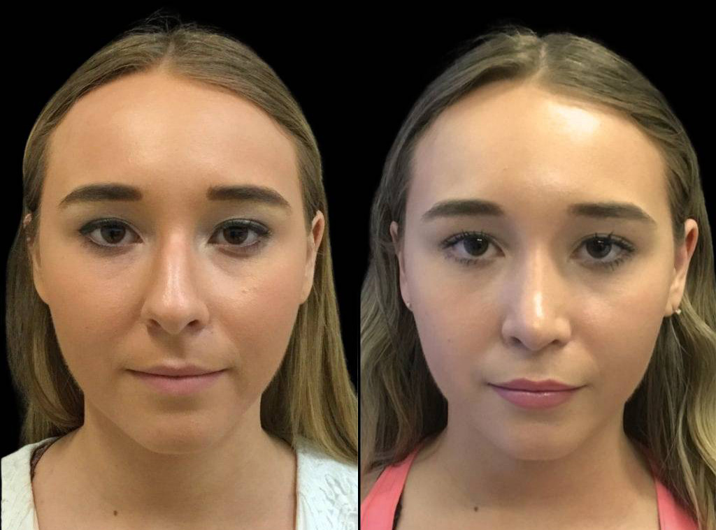 19-year-old-female-rhinoplasty-before-and-after-front-view-.jpg