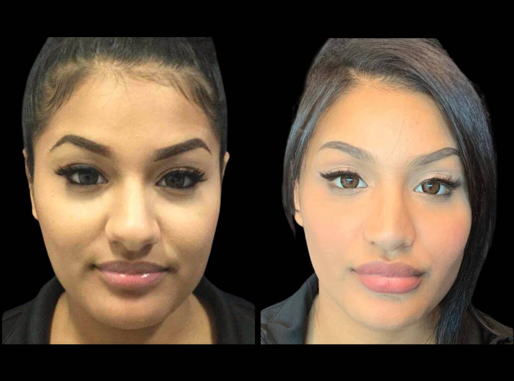 19-year-old-female-rhinoplasty-before-and-after-front-view-1.jpg