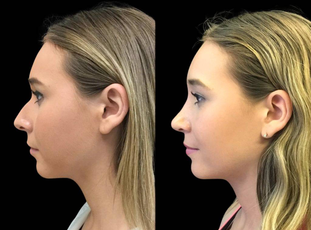 19-year-old-female-rhinoplasty-before-and-after-side-view-.jpg