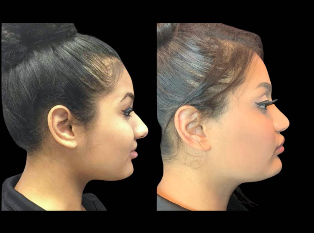 19-year-old-female-rhinoplasty-before-and-after-side-view-1.jpg