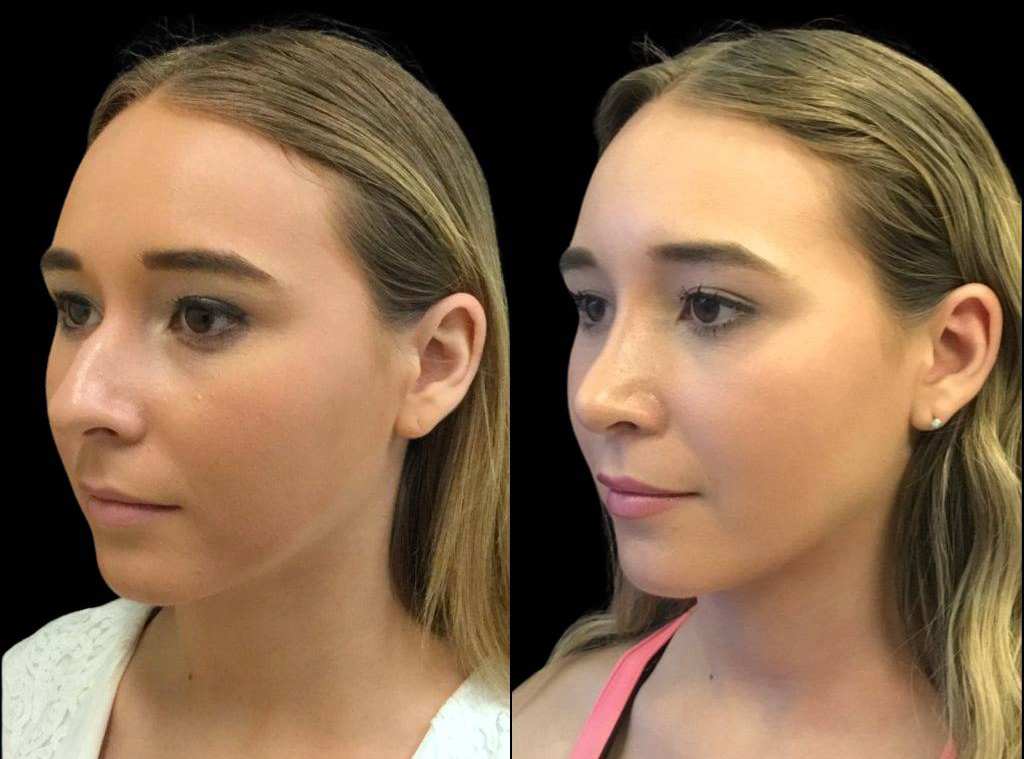 19-year-old-female-rhinoplasty-before-and-after-three-quarters-view-.jpg