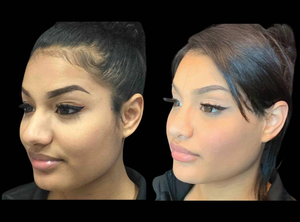 19-year-old-female-rhinoplasty-before-and-after-three-quarters-view-1.jpg