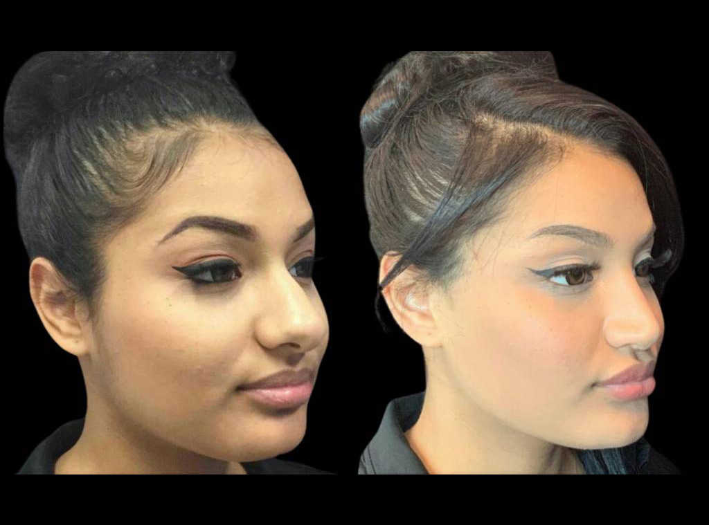 19-year-old-female-rhinoplasty-before-and-after-three-quarters-view-2.jpg