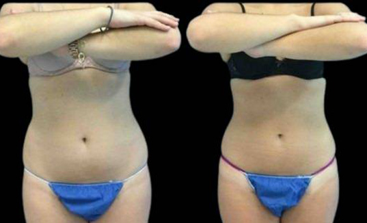 20-year-old-female-coolsculpting-before-and-after-front-view-.jpg