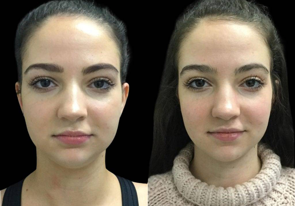 20-year-old-female-neck-liposuction-before-and-after-front-view-22435.jpg
