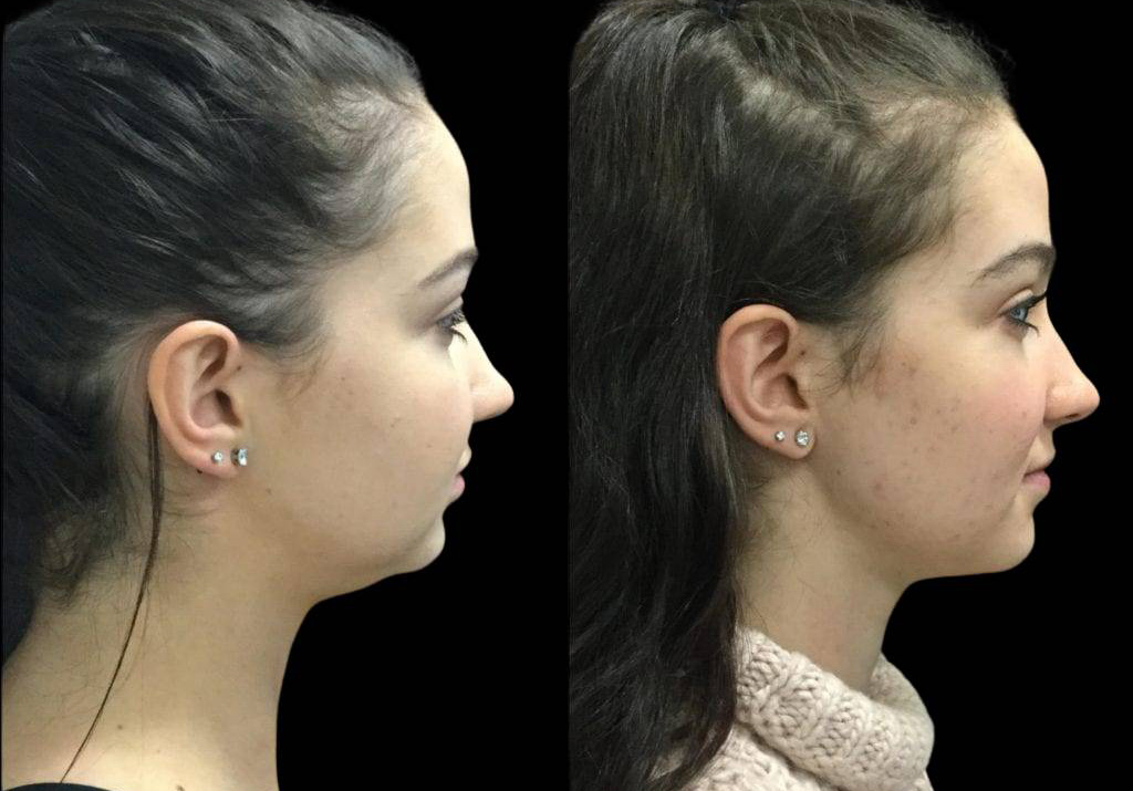 20-year-old-female-neck-liposuction-before-and-after-side-view.jpg
