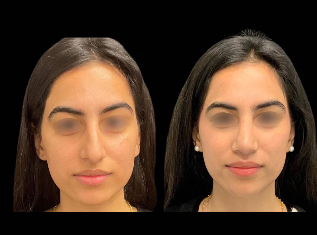 20-year-old-female-rhinoplasty-before-and-after-front-view-1.jpg