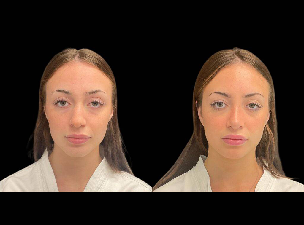 20-year-old-female-rhinoplasty-before-and-after-front-view.jpg