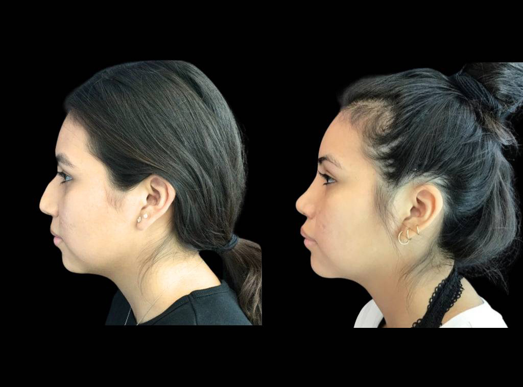 20-year-old-female-rhinoplasty-before-and-after-side-view-.jpg