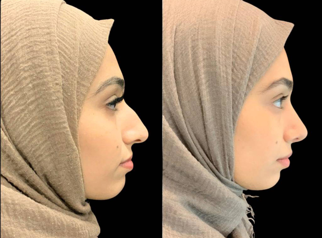 20-year-old-female-rhinoplasty-before-and-after-side-view-1.jpg