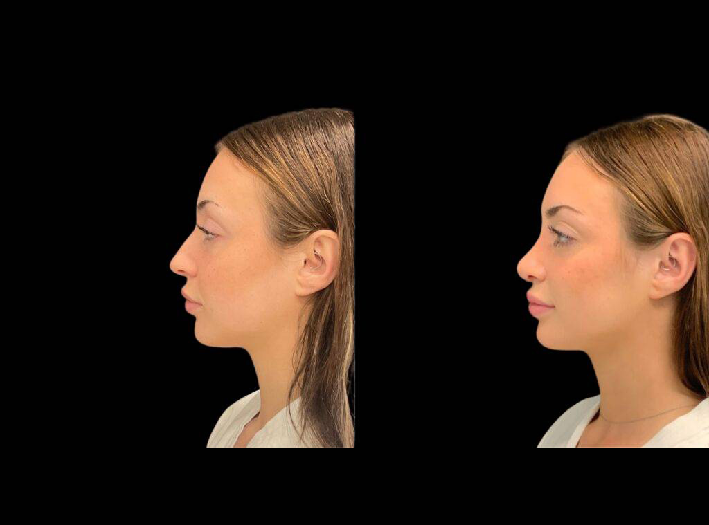 20-year-old-female-rhinoplasty-before-and-after-side-view-3.jpg