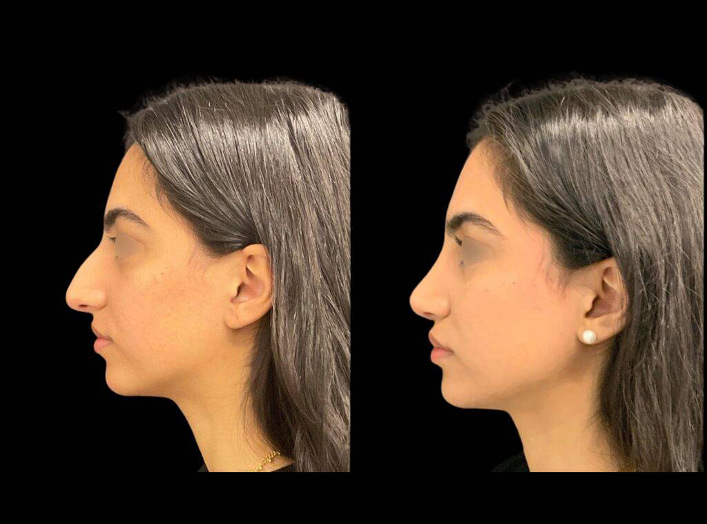 20-year-old-female-rhinoplasty-before-and-after-side-view-4.jpg
