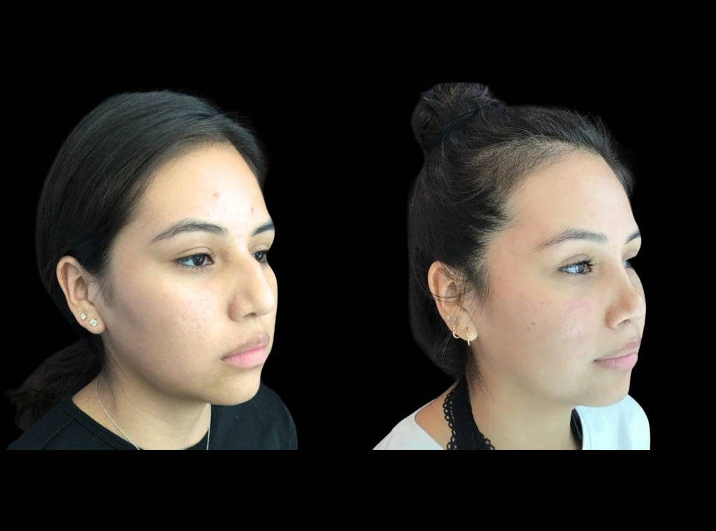 20-year-old-female-rhinoplasty-before-and-after-three-quarters-view-.jpg