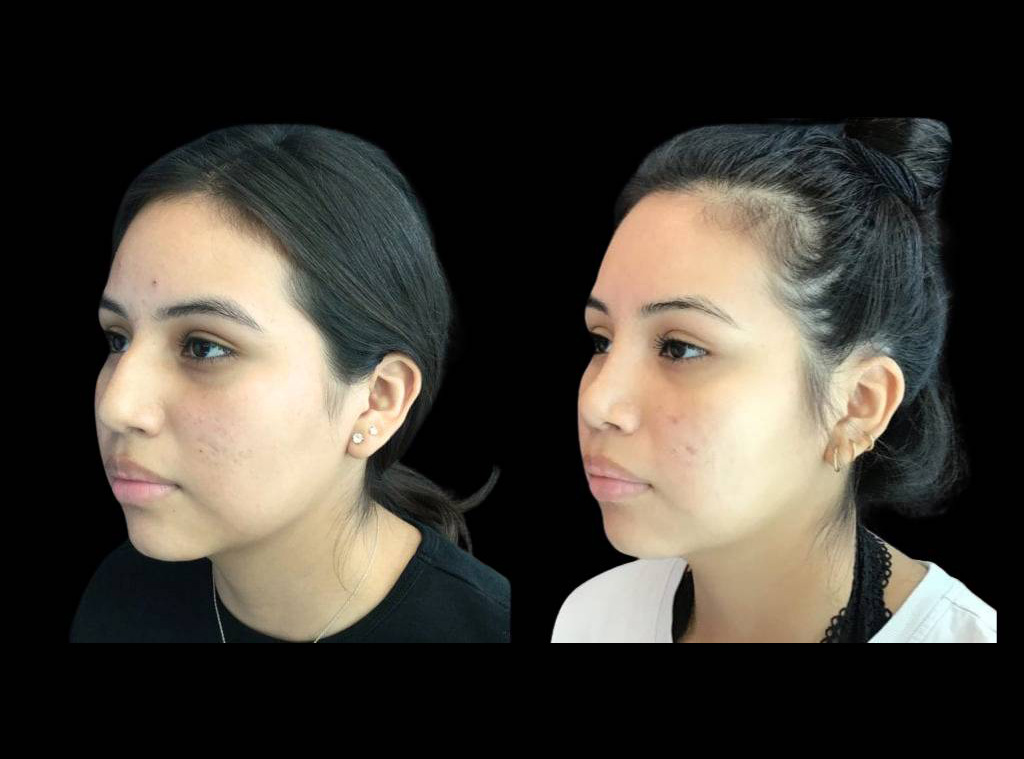 20-year-old-female-rhinoplasty-before-and-after-three-quarters-view-1.jpg