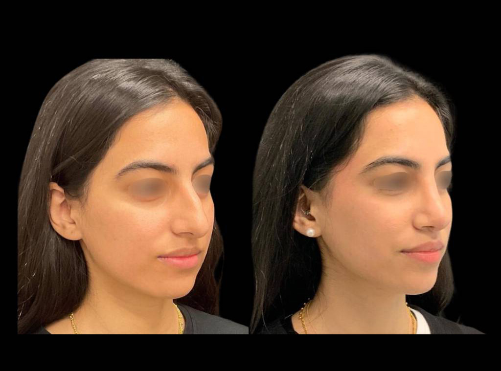 20-year-old-female-rhinoplasty-before-and-after-three-quarters-view-2-2.jpg