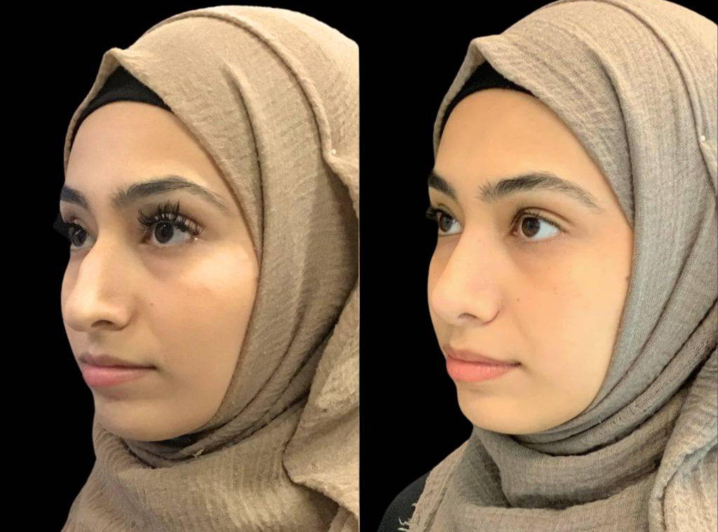20-year-old-female-rhinoplasty-before-and-after-three-quarters-view-2.jpg