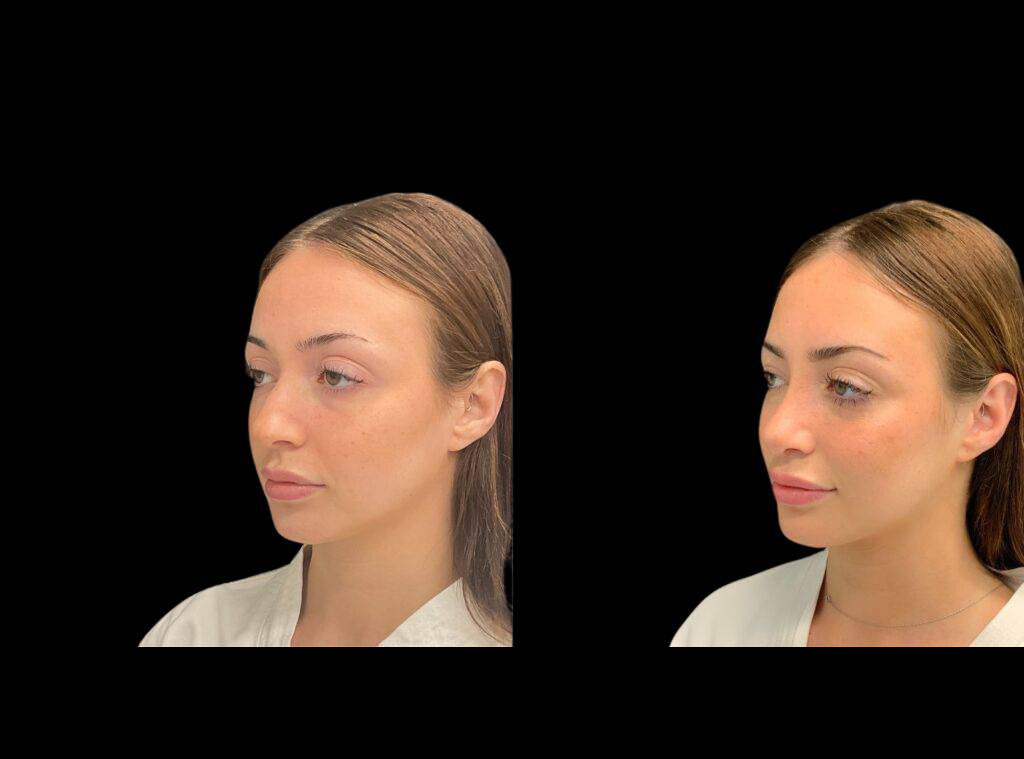 20-year-old-female-rhinoplasty-before-and-after-three-quarters-view-4.jpg