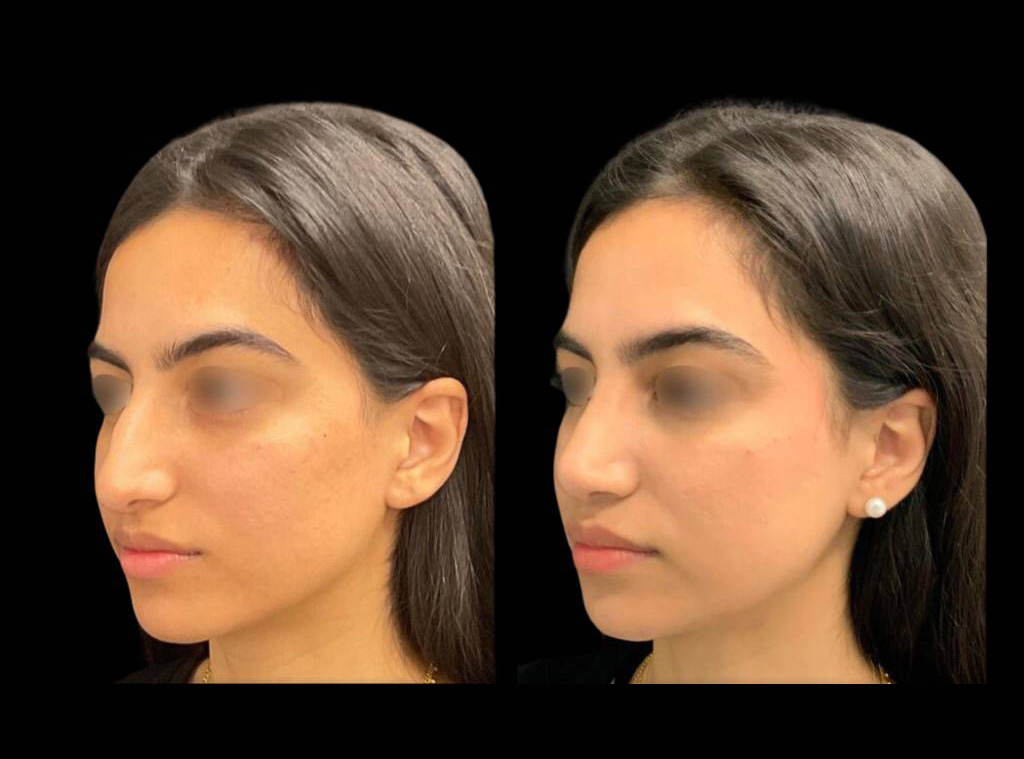 20-year-old-female-rhinoplasty-before-and-after-three-quarters-view-5.jpg