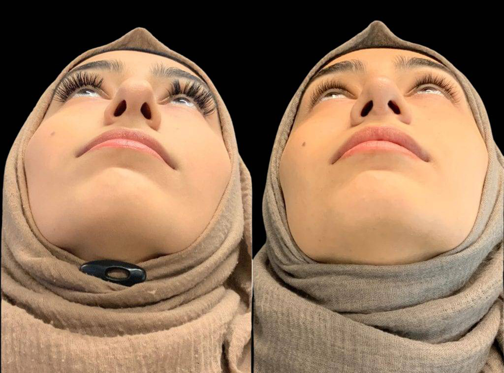 20-year-old-female-rhinoplasty-before-and-after-worms-eye-view-.jpg