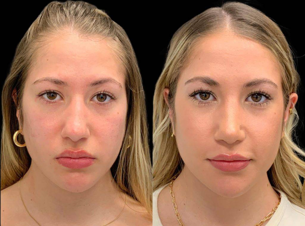 20-year-old-female-rhinoplasty-front-view-31865.jpg