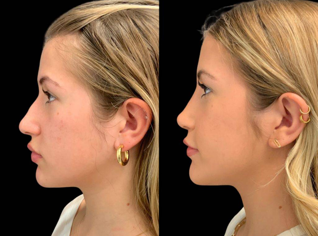 20-year-old-female-rhinoplasty-side-view-31865.jpg