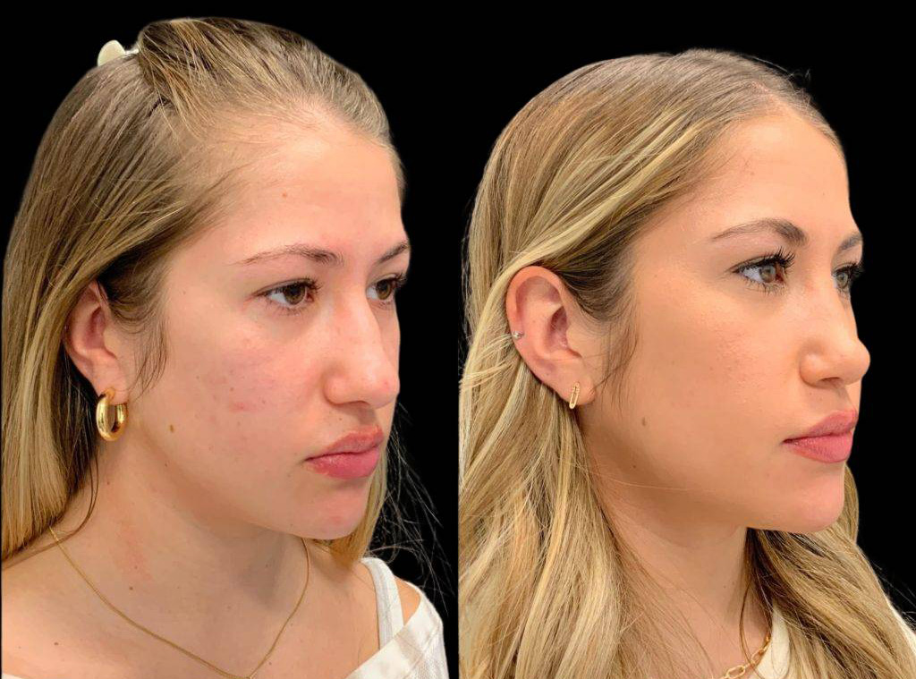20-year-old-female-rhinoplasty-three-quarters-view-31865.jpg