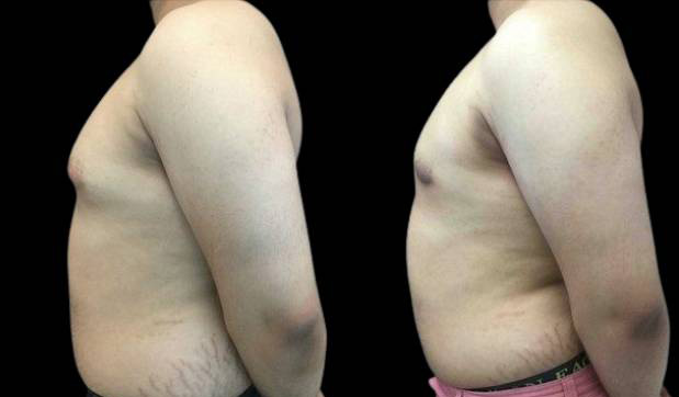 20-year-old-male-breast-reduction-before-and-after-side-view-1.jpg