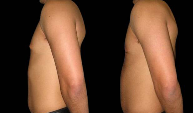20-year-old-male-breast-reduction-before-and-after-side-view.jpg