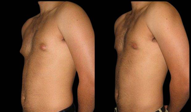 20-year-old-male-breast-reduction-before-and-after-three-quarter-view-1.jpg
