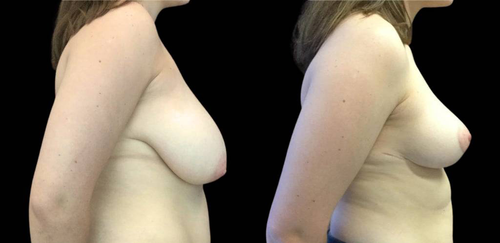 21-year-old-female-breast-reduction-before-and-after-side-view.jpg