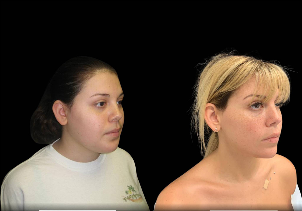 21-year-old-female-chin-implant-before-and-after-three-quarter-view-.jpg