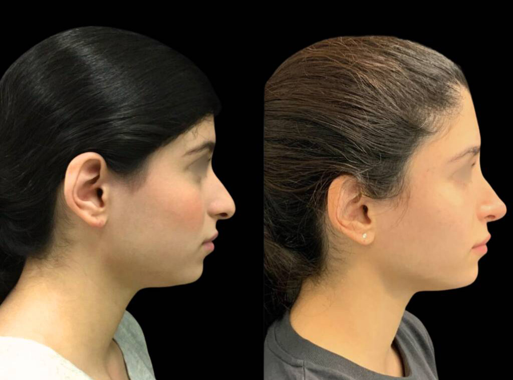 21-year-old-female-rhinoplasty-before-and-after-side-view-.jpg