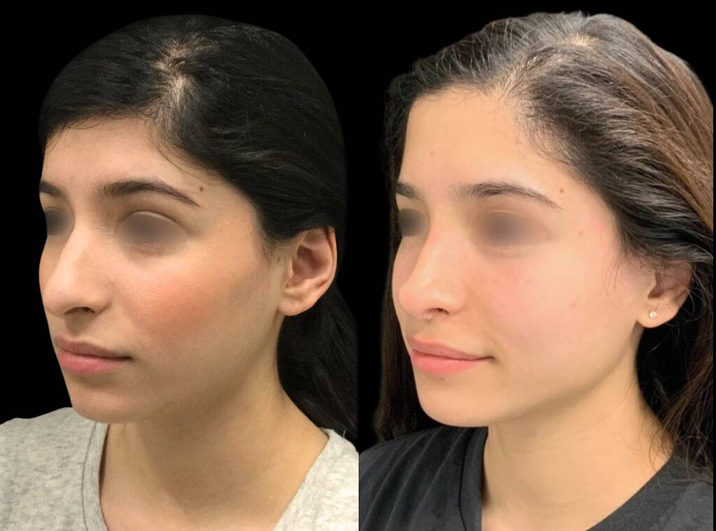 21-year-old-female-rhinoplasty-before-and-after-three-quarters-view-.jpg