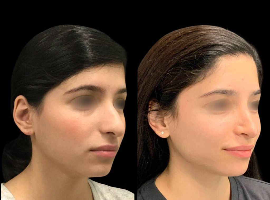 21-year-old-female-rhinoplasty-before-and-after-three-quarters-view-1.jpg