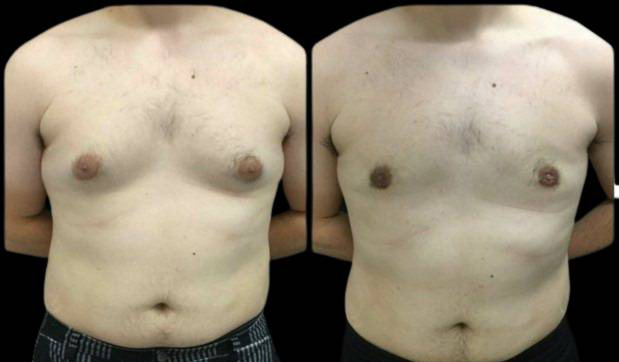 21-year-old-male-breast-reduction-before-and-after-front-view.jpg