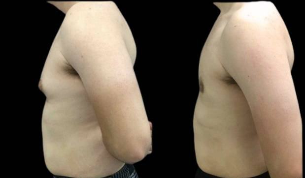 21-year-old-male-breast-reduction-before-and-after-side-view.jpg