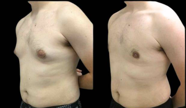 21-year-old-male-breast-reduction-before-and-after-three-quarter-view.jpg