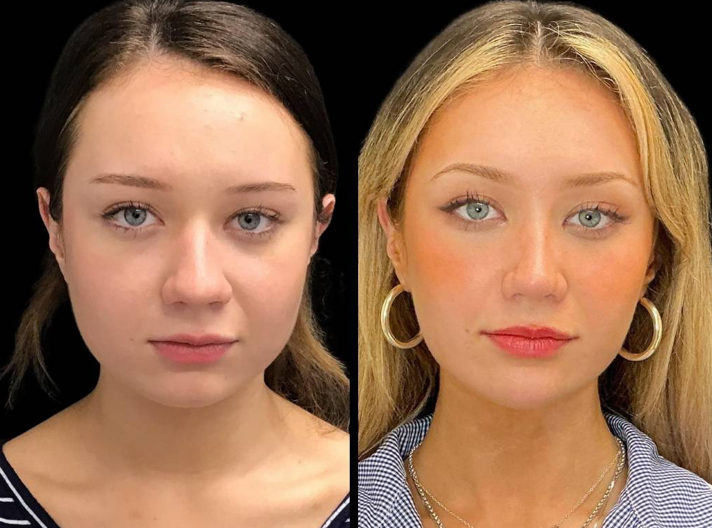 21-yr-old-female-rhinoplasty-before-and-after-front-view.jpg