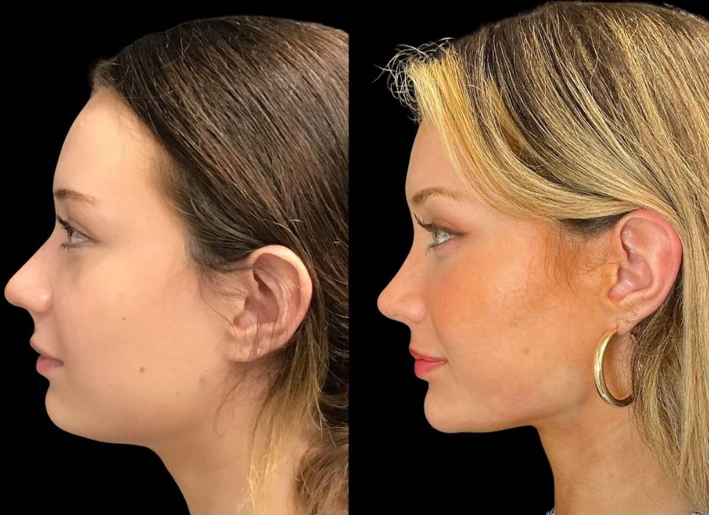 21-yr-old-female-rhinoplasty-before-and-after-left-view.jpg