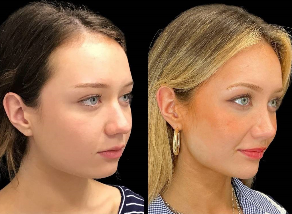 21-yr-old-female-rhinoplasty-before-and-after-right-three-quarter-view.jpg