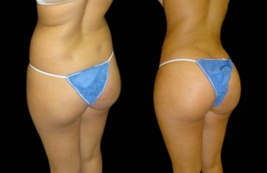 This is a 22-year-old female that has had a brazilian butt lift showing the before and after's side-by-side