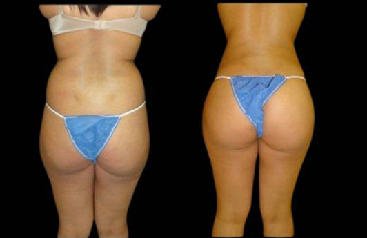 This is a 22-year-old female that has had a brazilian butt lift showing the before and after's side-by-side