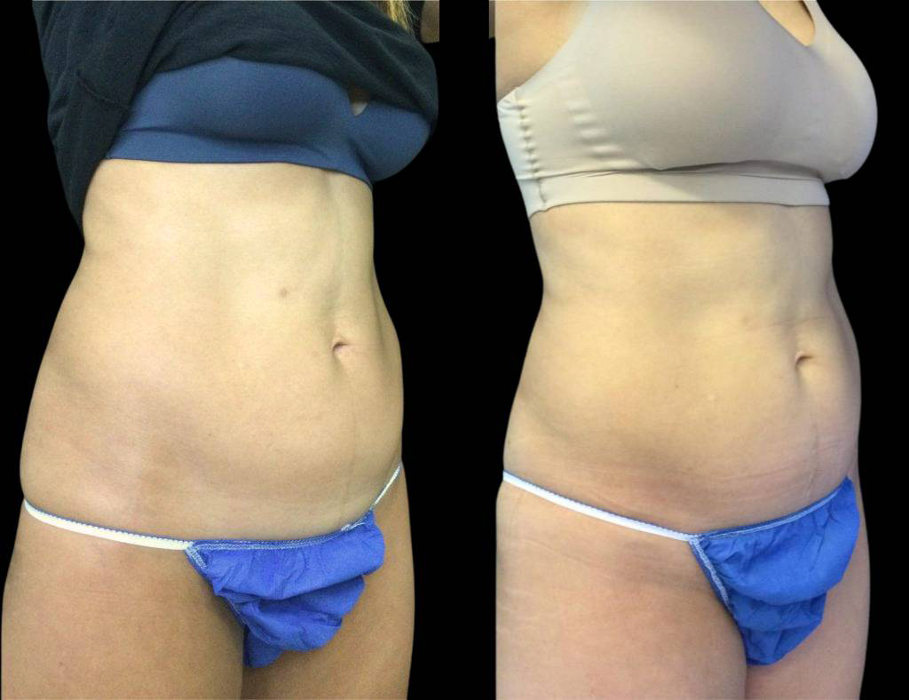 22-year-old-female-emsculpt-before-and-after.jpg