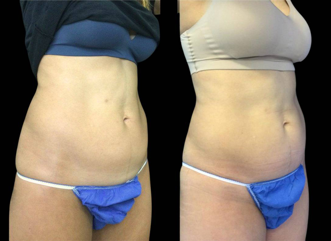 22-year-old-female-emsculpt-before-and-after.jpg