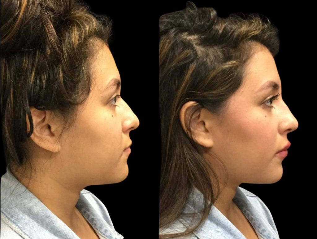 22-year-old-female-juvederm-before-and-after-side-view.jpg
