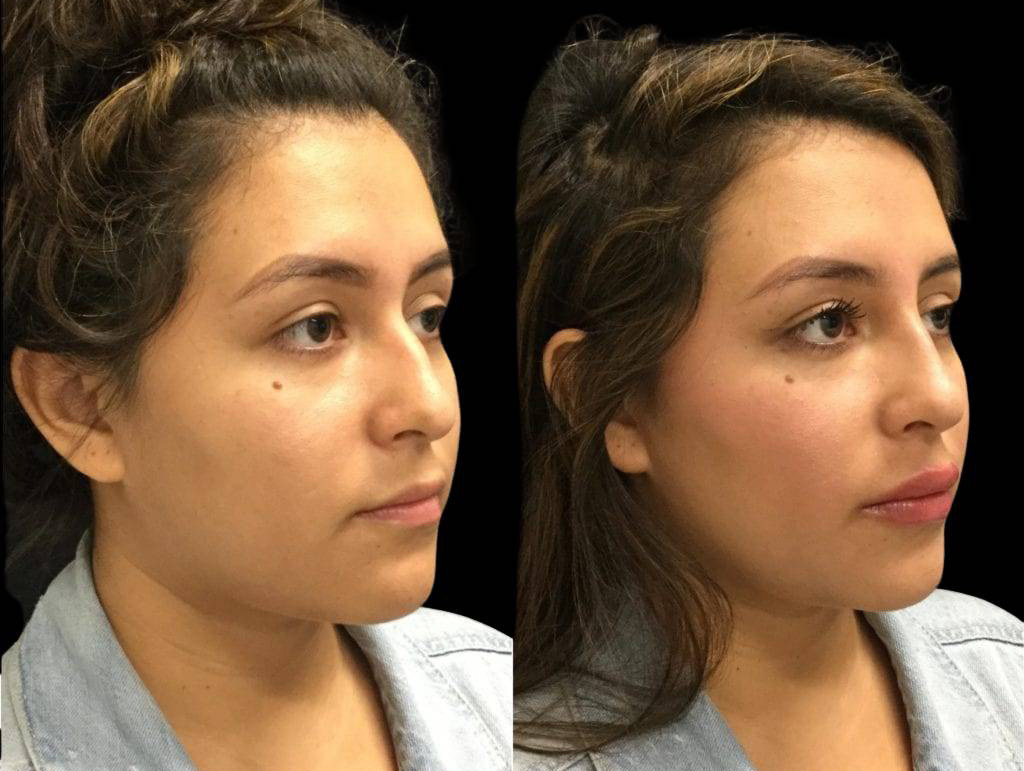 22-year-old-female-juvederm-before-and-after-three-quarter-view-28220.jpg