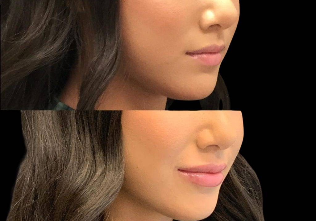 22-year-old-female-lip-augmentation-before-and-after-1.jpg